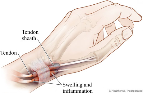 Chirurgia della mano - sindrome di de quervain