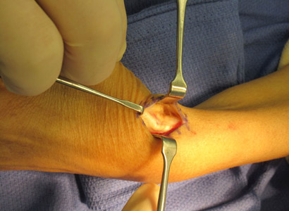 Chirurgia della mano - sindrome di de quervain