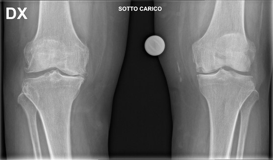 Chirurgia protesica del ginocchio